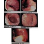 Upper GI endoscopy of the presented case.