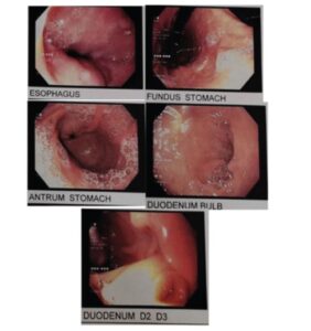 Upper GI endoscopy of the presented case.